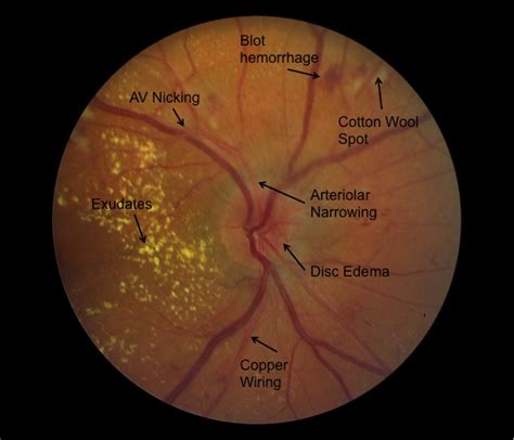 fundoscopic findings in hypertension.